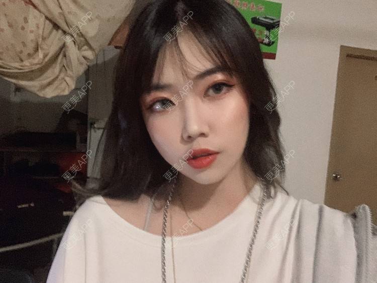 更美 - 淑女注意你的仪态的自体脂肪全面部填充经验 | 杭州 | 自体脂肪全面部填充