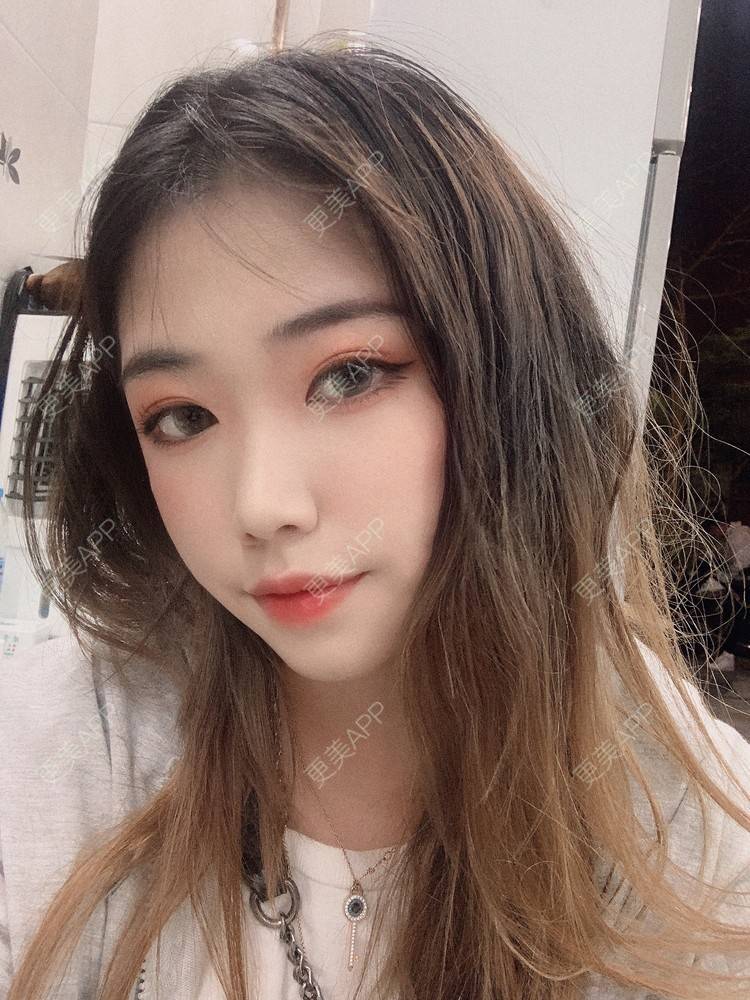 更美 - 淑女注意你的仪态的自体脂肪全面部填充经验 | 杭州 | 自体脂肪全面部填充