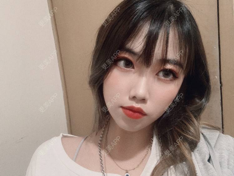更美 - 淑女注意你的仪态的自体脂肪全面部填充经验 | 杭州 | 自体脂肪全面部填充