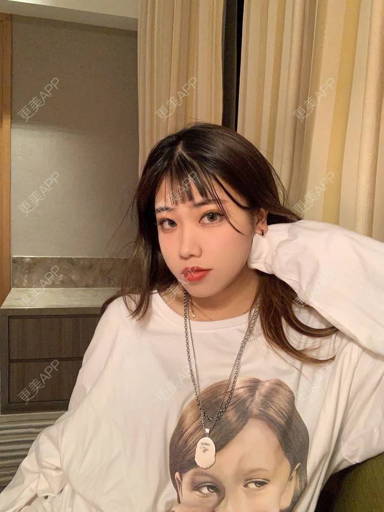 更美 - 淑女注意你的仪态的自体脂肪全面部填充经验 | 杭州 | 自体脂肪全面部填充