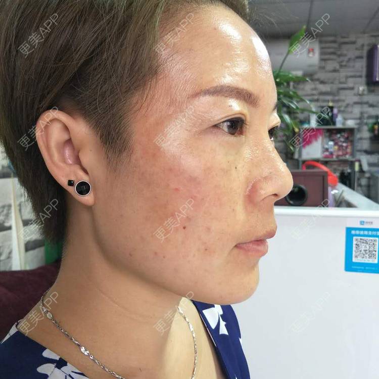 更美 - 不变的唯十二的外切去眼袋经验 | 外切去眼袋 | 成都