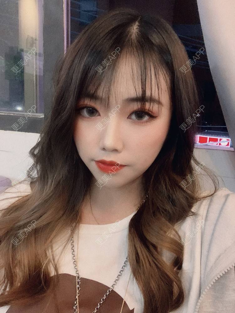 更美 - 淑女注意你的仪态的自体脂肪全面部填充经验 | 杭州 | 自体脂肪全面部填充