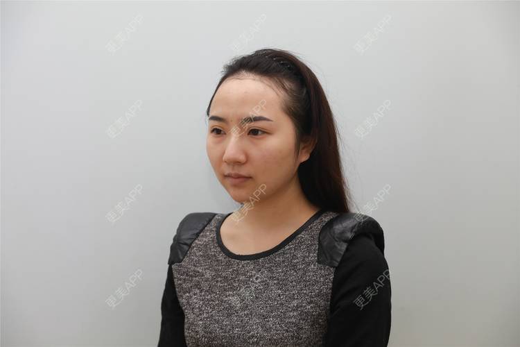 更美 - 更美用户iUNmoM6eZJ的植发际线经验 | 植发际线