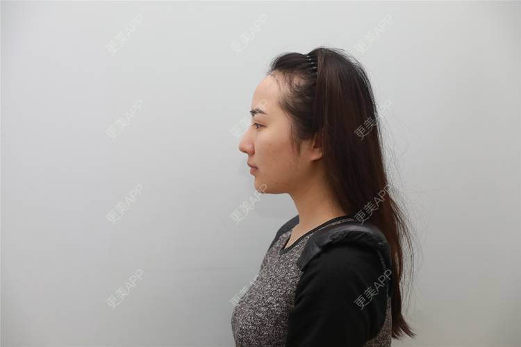 更美 - 更美用户iUNmoM6eZJ的植发际线经验 | 植发际线