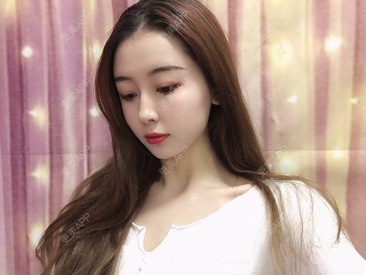 更美 - 静姐姐呀的自体脂肪全面部填充经验 | 杭州 | 自体脂肪全面部填充