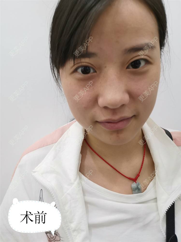 更美 - 紫绿葡萄的眼部修复经验 | 眼部修复 | 重庆