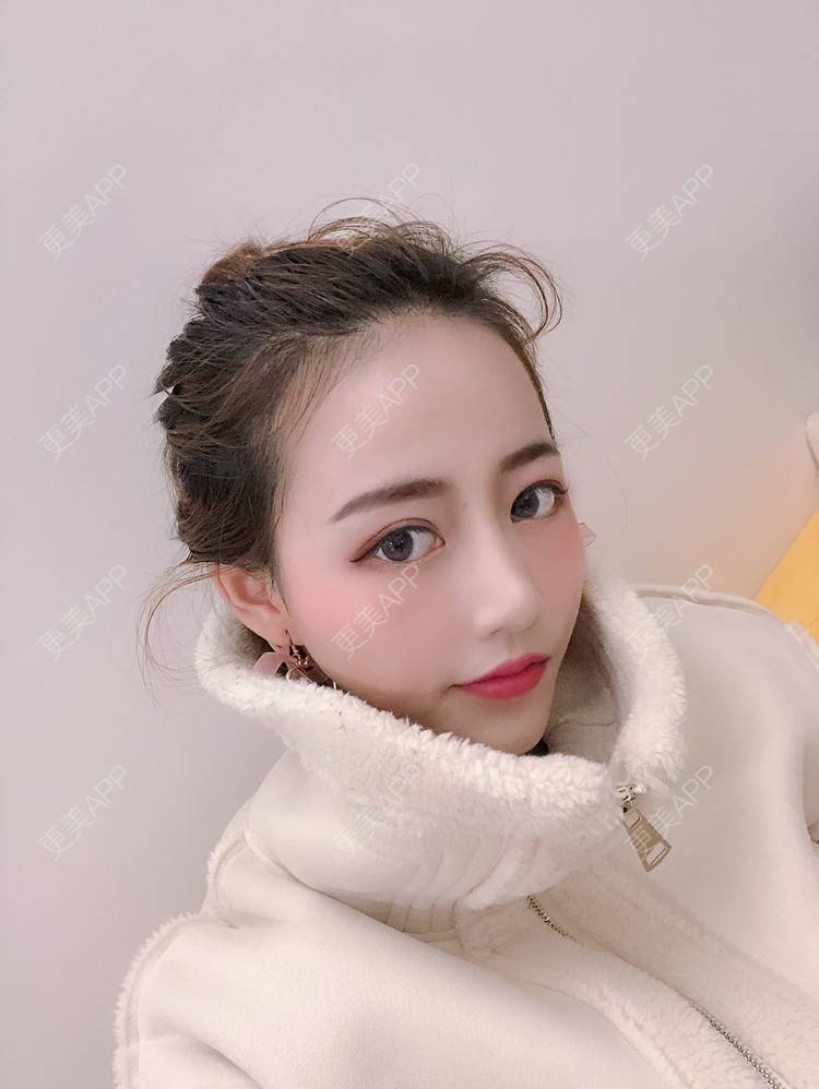 更美 - 是见见啊的自体脂肪丰面颊经验 | 杭州 | 视频日记 | 自体脂肪丰面颊