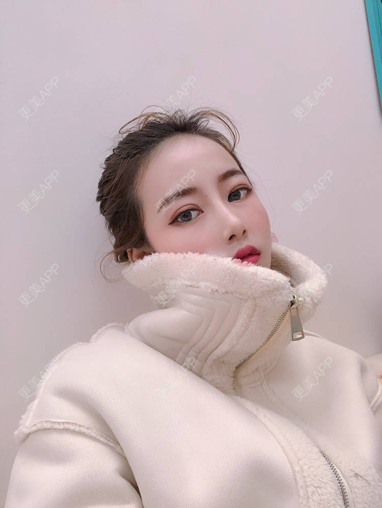 更美 - 是见见啊的自体脂肪丰面颊经验 | 杭州 | 视频日记 | 自体脂肪丰面颊