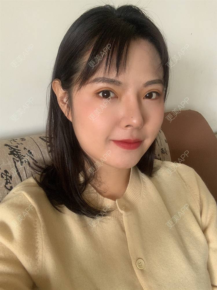 更美 - 落花和忆梦的鼻形态修复经验 | 重庆 | 鼻形态修复
