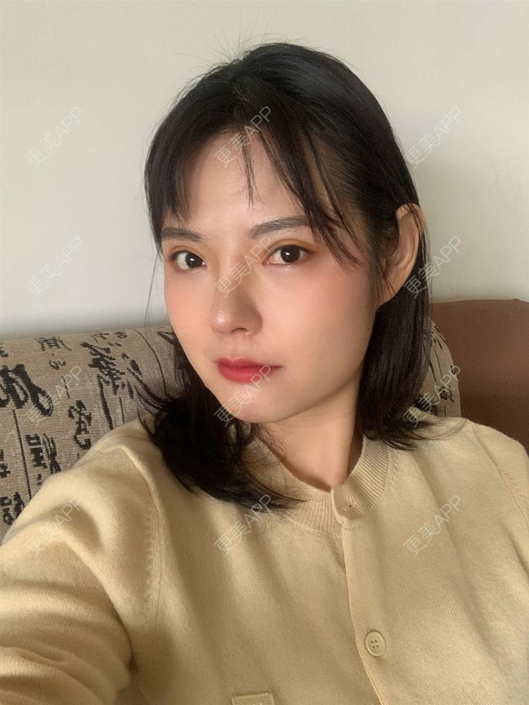 更美 - 落花和忆梦的双眼皮修复经验 | 重庆 | 双眼皮修复