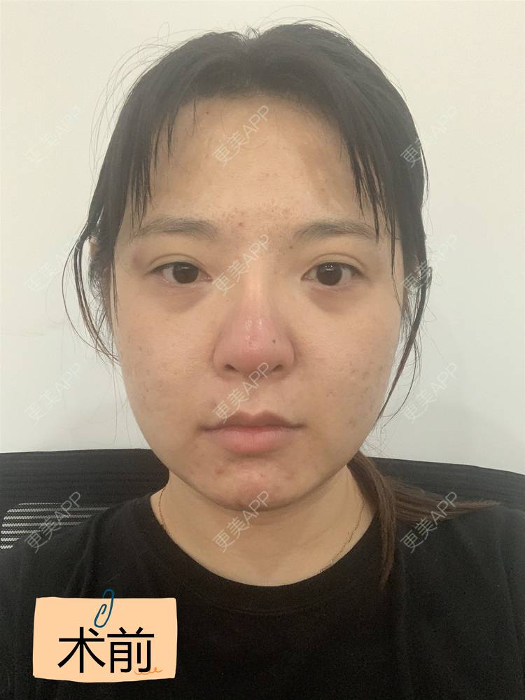 更美 - 落花和忆梦的双眼皮修复经验 | 重庆 | 双眼皮修复