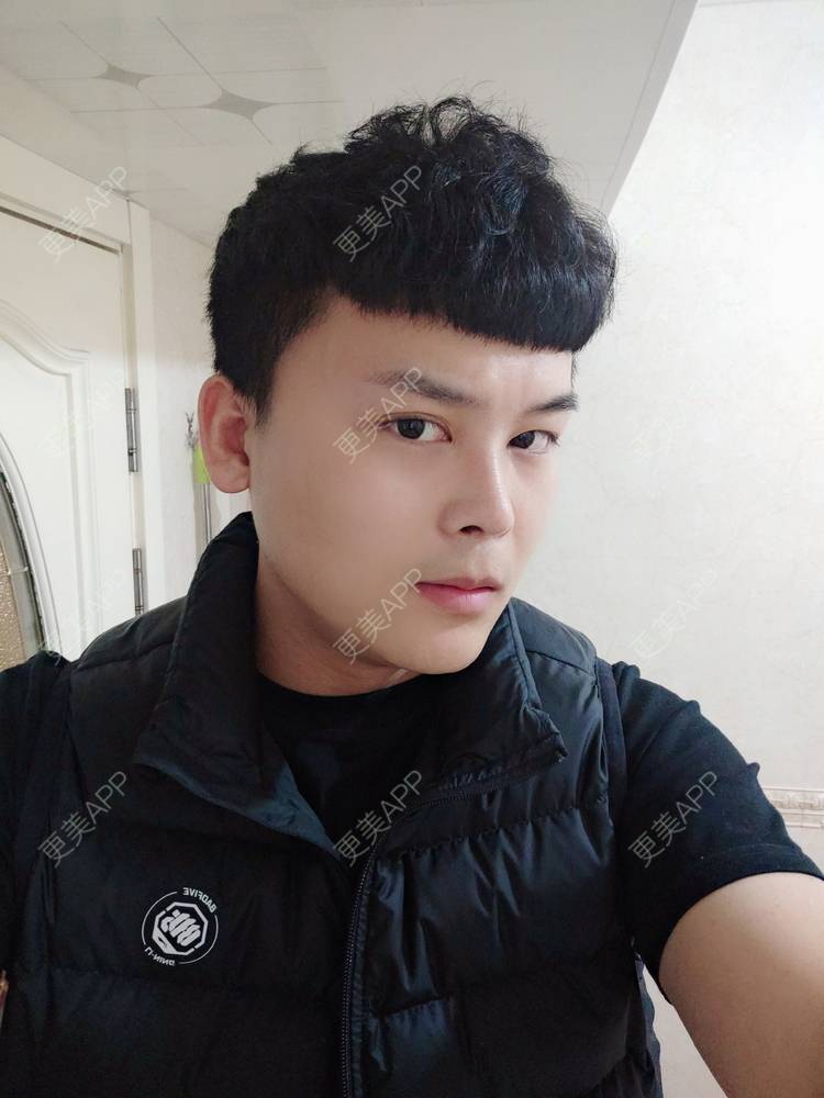 更美 - Mr🐔哦啦啦的隆鼻经验 | 隆鼻 | 鼻部多项 | 重庆