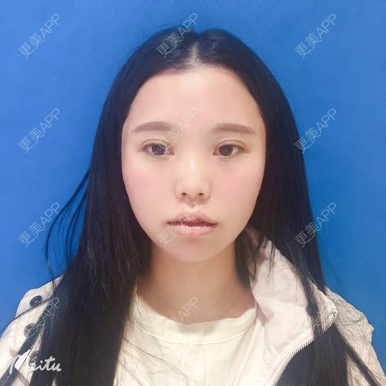 更美 - 更美用户OJ9N26JLYR的M唇成形经验 | M唇成形 | 重庆