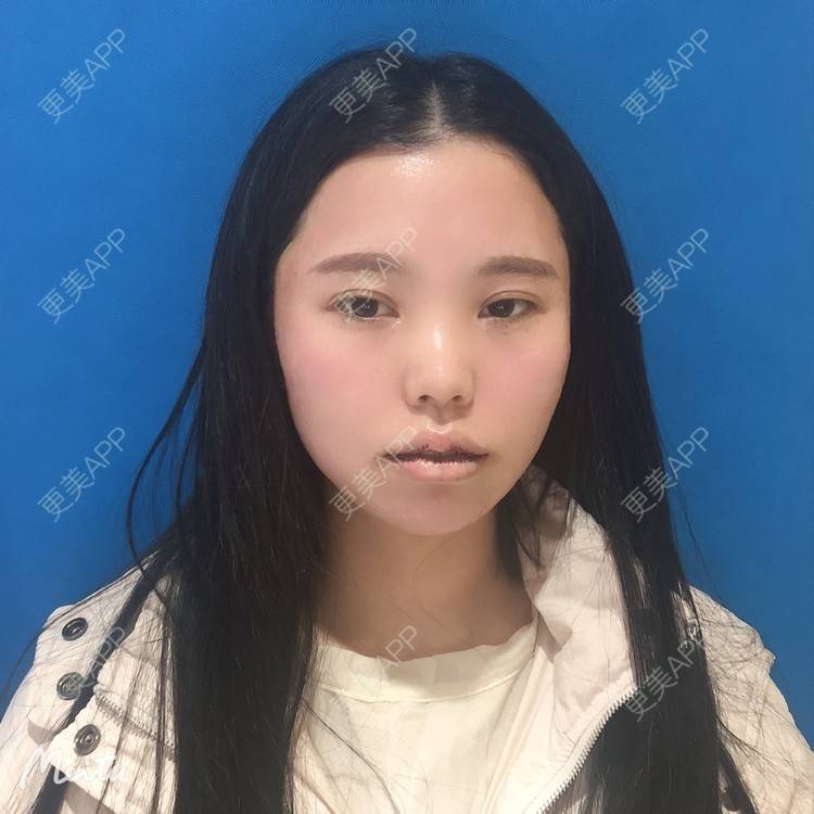 更美 - 更美用户OJ9N26JLYR的M唇成形经验 | M唇成形 | 重庆