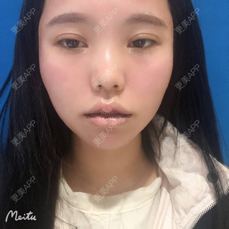 更美 - 更美用户OJ9N26JLYR的M唇成形经验 | M唇成形 | 重庆