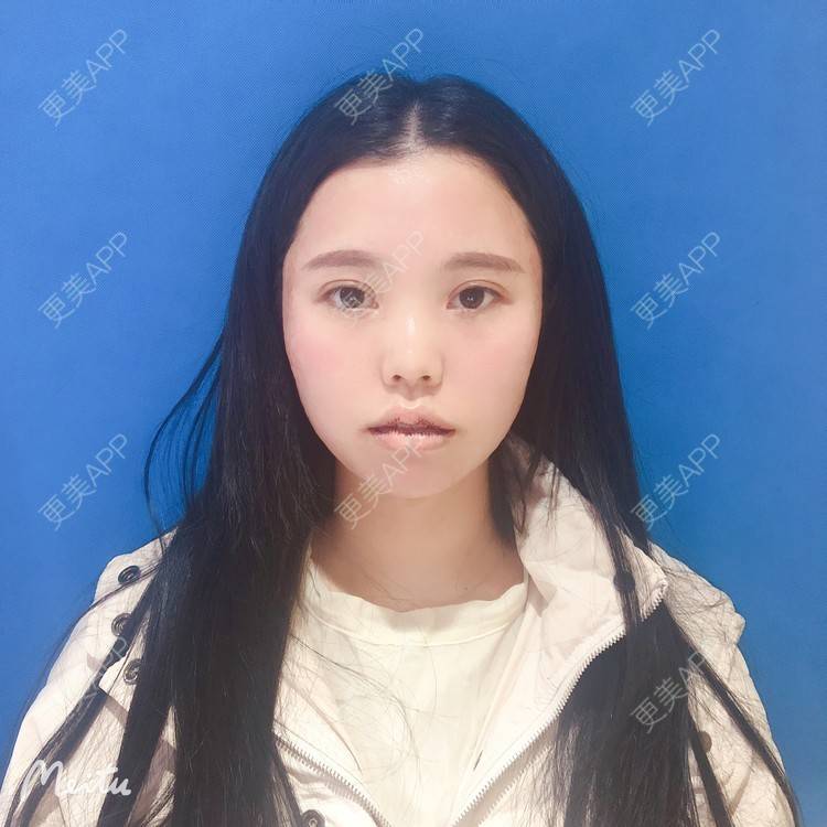 更美 - 更美用户OJ9N26JLYR的M唇成形经验 | M唇成形 | 重庆