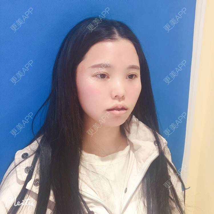 更美 - 更美用户OJ9N26JLYR的M唇成形经验 | M唇成形 | 重庆