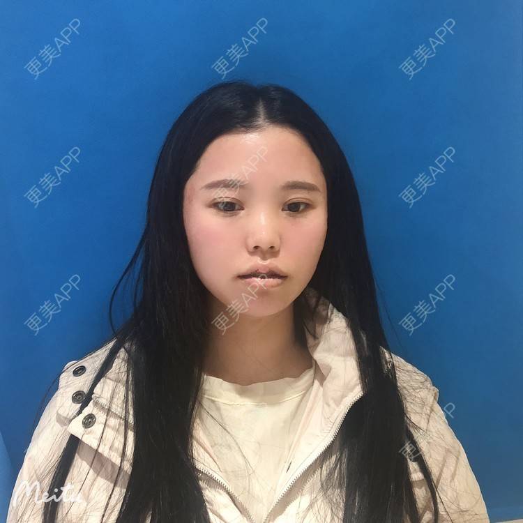 更美 - 更美用户OJ9N26JLYR的M唇成形经验 | M唇成形 | 重庆