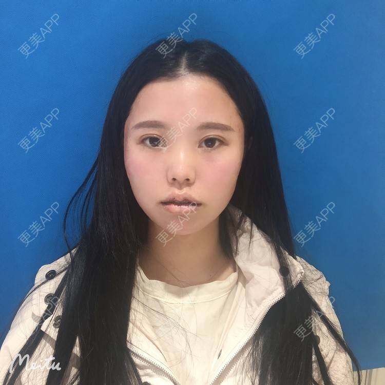 更美 - 更美用户OJ9N26JLYR的M唇成形经验 | M唇成形 | 重庆