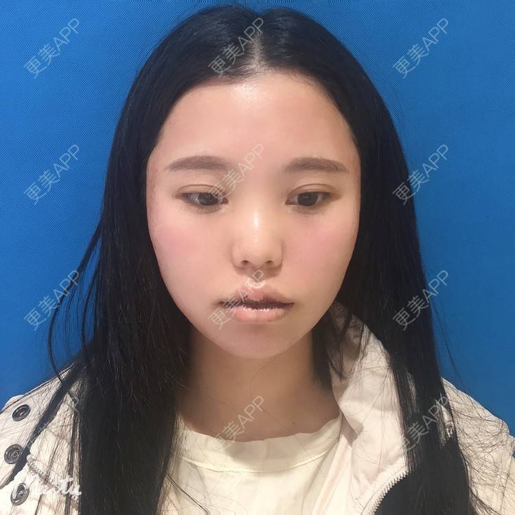 更美 - 更美用户OJ9N26JLYR的M唇成形经验 | M唇成形 | 重庆