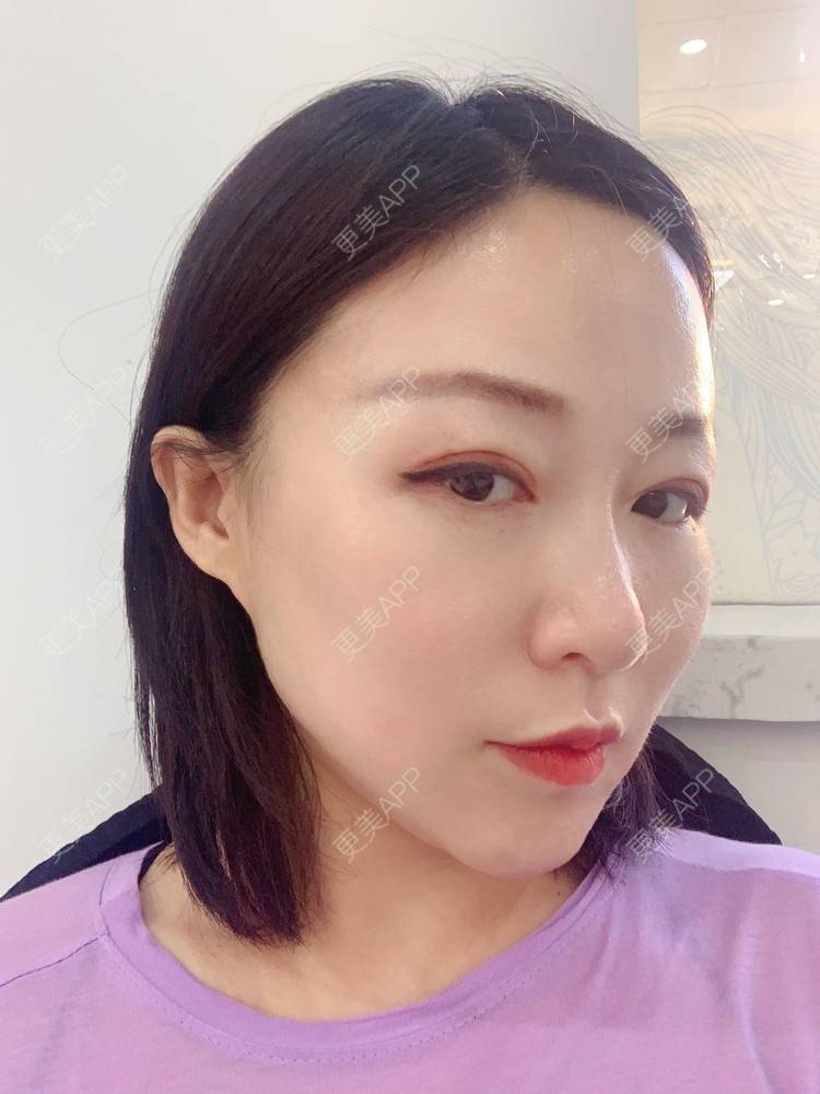 更美 - 更美用户76GAe14Xl1的热玛吉经验 | 热玛吉 | 北京