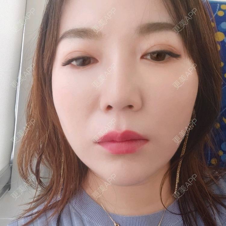 更美 - 更美用户kJHsTQZQuS的吸脂瘦脸经验 | 吸脂瘦脸 | 上海 | 射频溶脂瘦脸