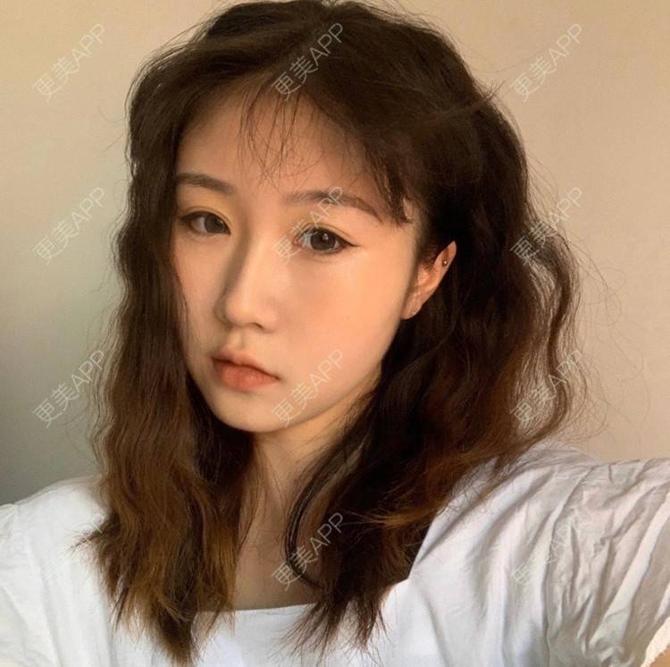 更美 - 更美用户d9MjKQYifr的经验 | 视频日记 | 沈阳 | 自体脂肪全面部填充