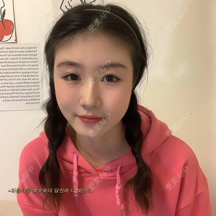 更美 - 更美用户d9MjKQYifr的经验 | 视频日记 | 沈阳 | 自体脂肪全面部填充