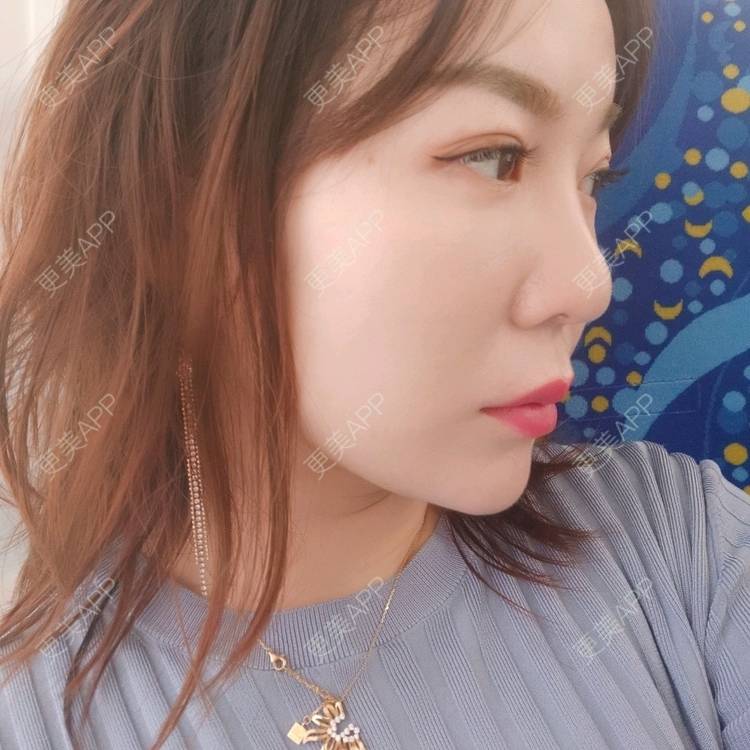 更美 - 更美用户kJHsTQZQuS的吸脂瘦脸经验 | 吸脂瘦脸 | 上海 | 射频溶脂瘦脸
