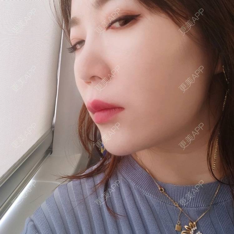 更美 - 更美用户kJHsTQZQuS的吸脂瘦脸经验 | 吸脂瘦脸 | 上海 | 射频溶脂瘦脸