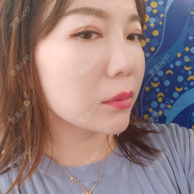 更美 - 更美用户kJHsTQZQuS的吸脂瘦脸经验 | 吸脂瘦脸 | 上海 | 射频溶脂瘦脸