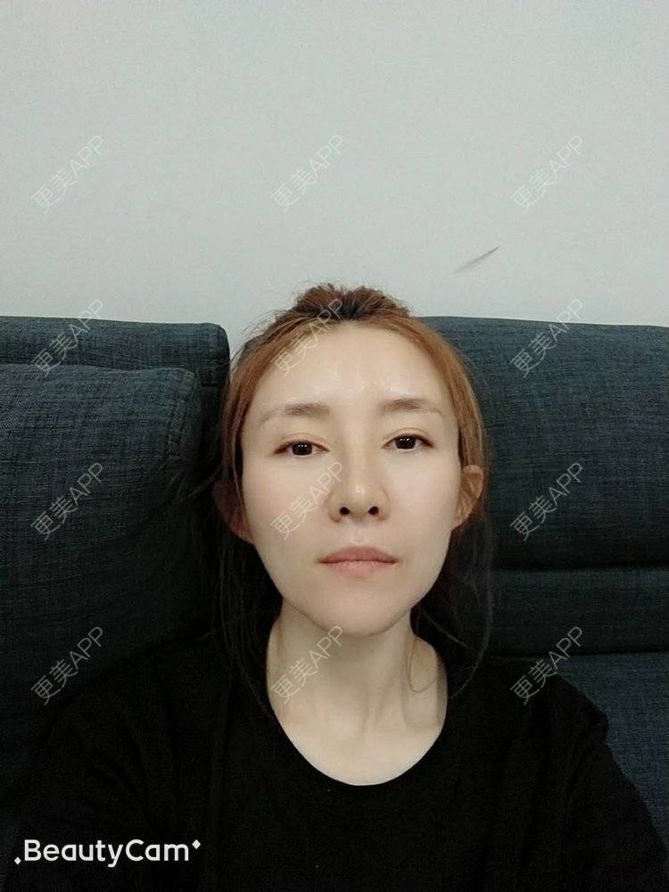 更美 - 更美用户asvACmcoDf的热玛吉经验 | 热玛吉 | 北京