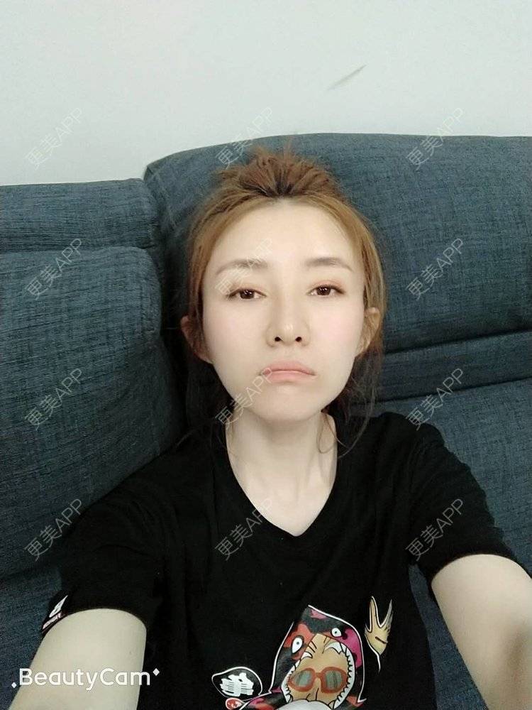 更美 - 更美用户asvACmcoDf的热玛吉经验 | 热玛吉 | 北京