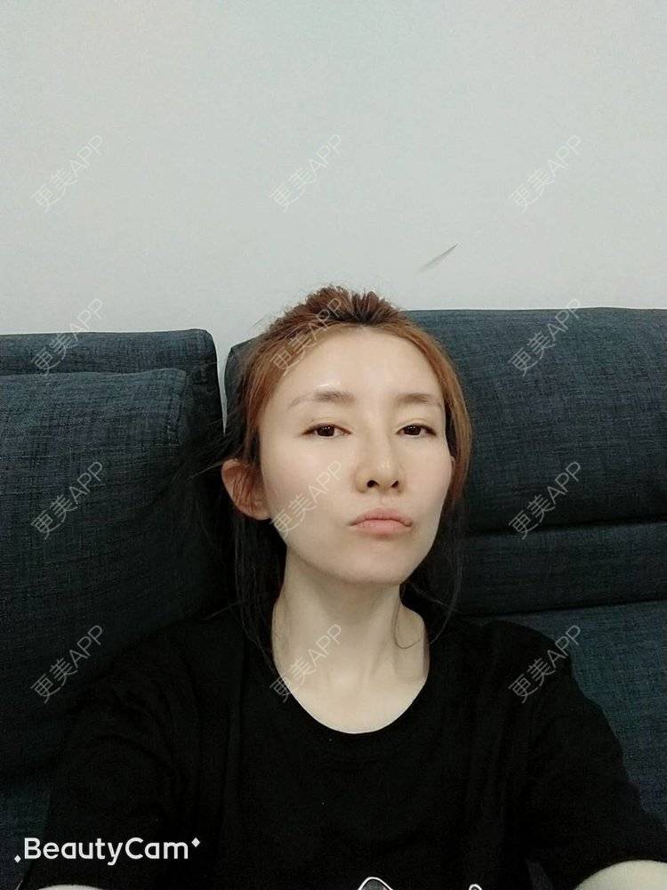 更美 - 更美用户asvACmcoDf的热玛吉经验 | 热玛吉 | 北京
