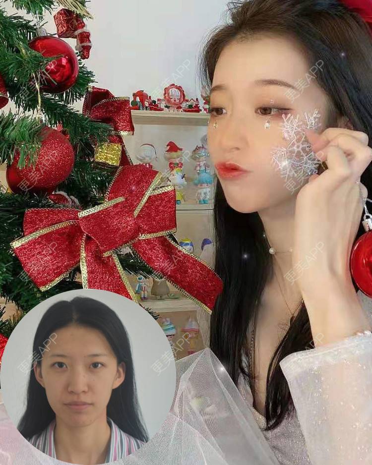 更美 - 更美用户ErPnovEm6s的经验 | 视频日记 | 沈阳 | 自体脂肪全面部填充