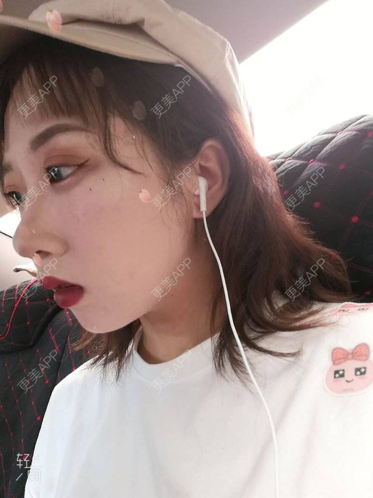 更美 - 更美用户Y99XxcShbA的热玛吉经验 | 热玛吉 | 北京