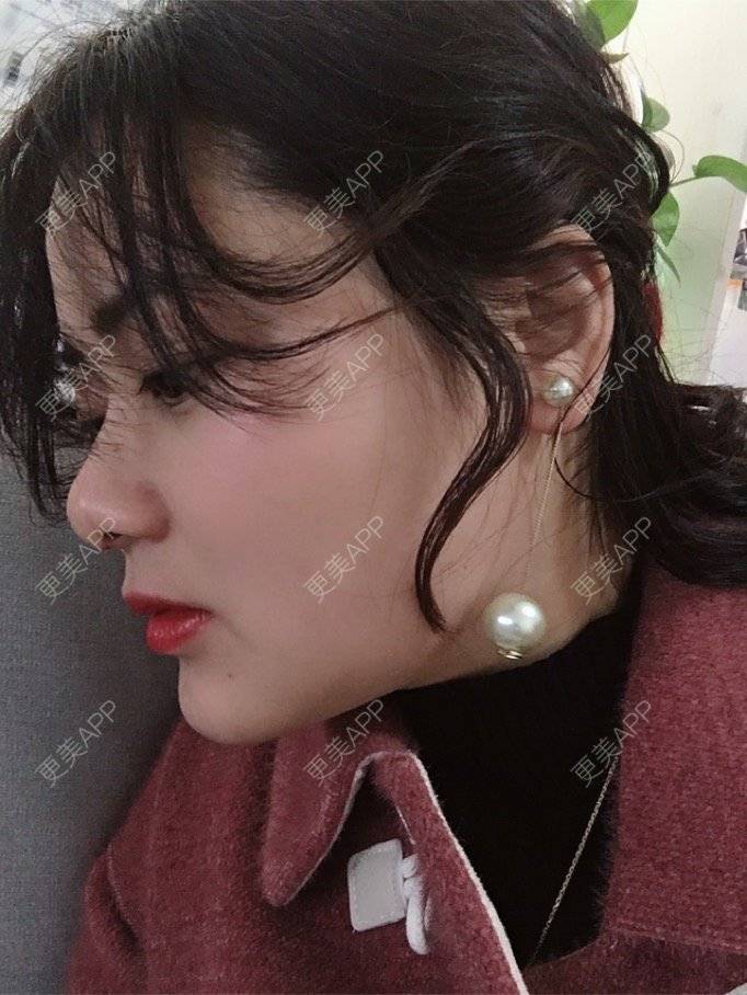 更美 - 阿狸萌萌哒💋的下颌角经验 | 下颌角 | 珠海 | 下颌角切除 | 视频日记