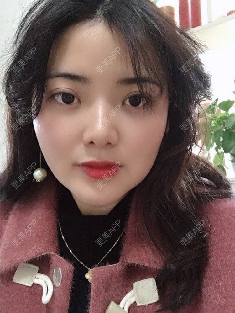更美 - 阿狸萌萌哒💋的下颌角经验 | 下颌角 | 珠海 | 下颌角切除 | 视频日记