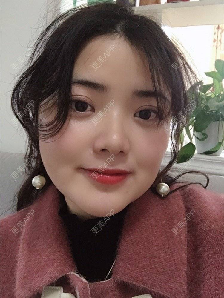 更美 - 阿狸萌萌哒💋的下颌角经验 | 下颌角 | 珠海 | 下颌角切除 | 视频日记
