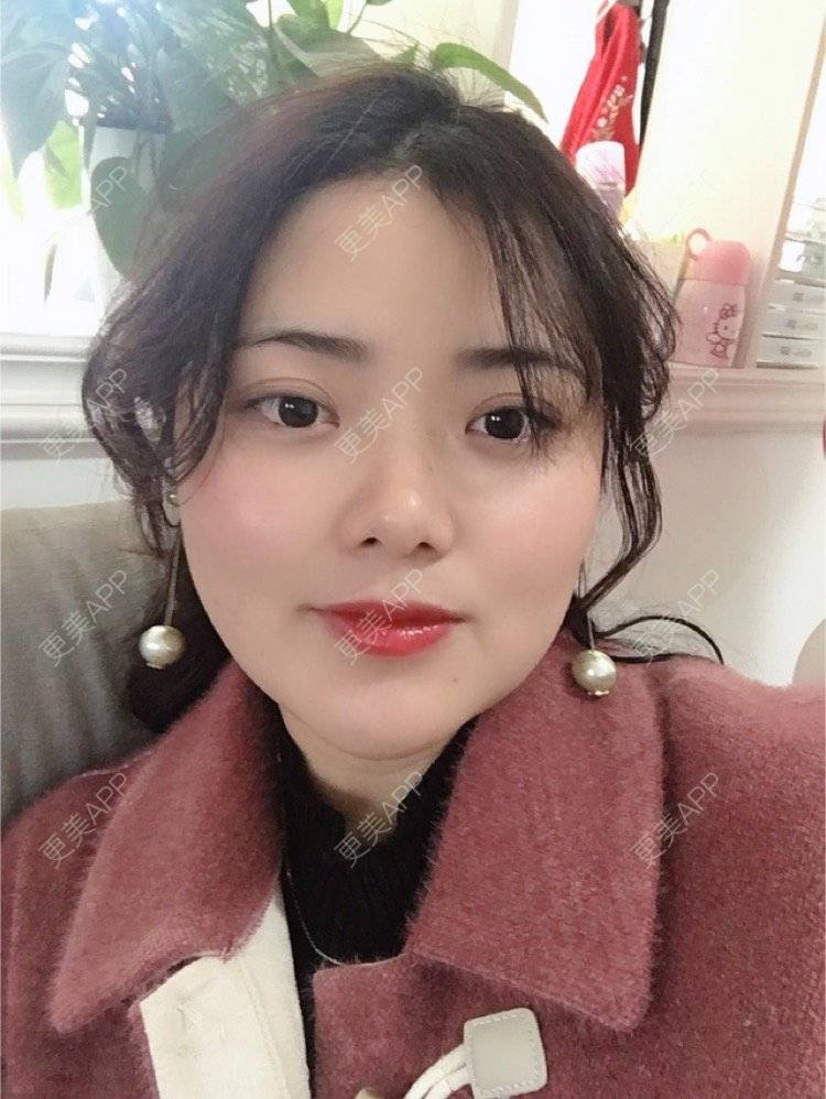 更美 - 阿狸萌萌哒💋的下颌角经验 | 下颌角 | 珠海 | 下颌角切除 | 视频日记