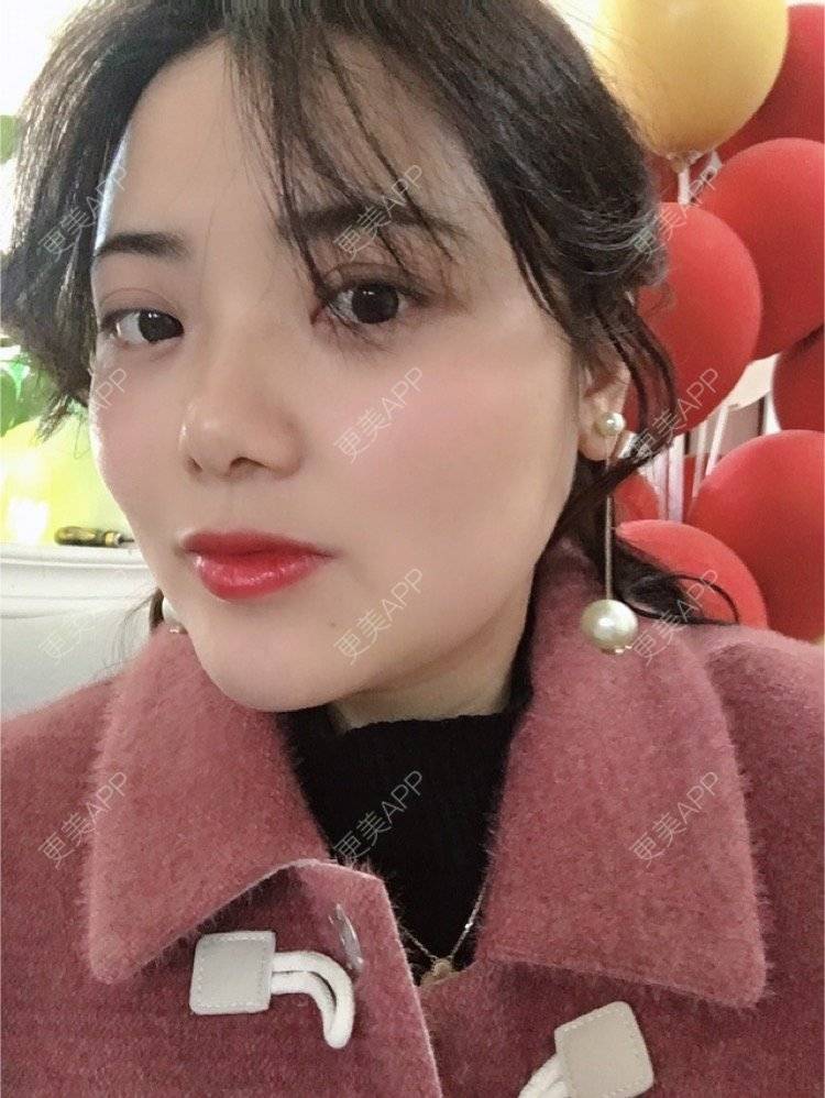 更美 - 阿狸萌萌哒💋的下颌角经验 | 下颌角 | 珠海 | 下颌角切除 | 视频日记