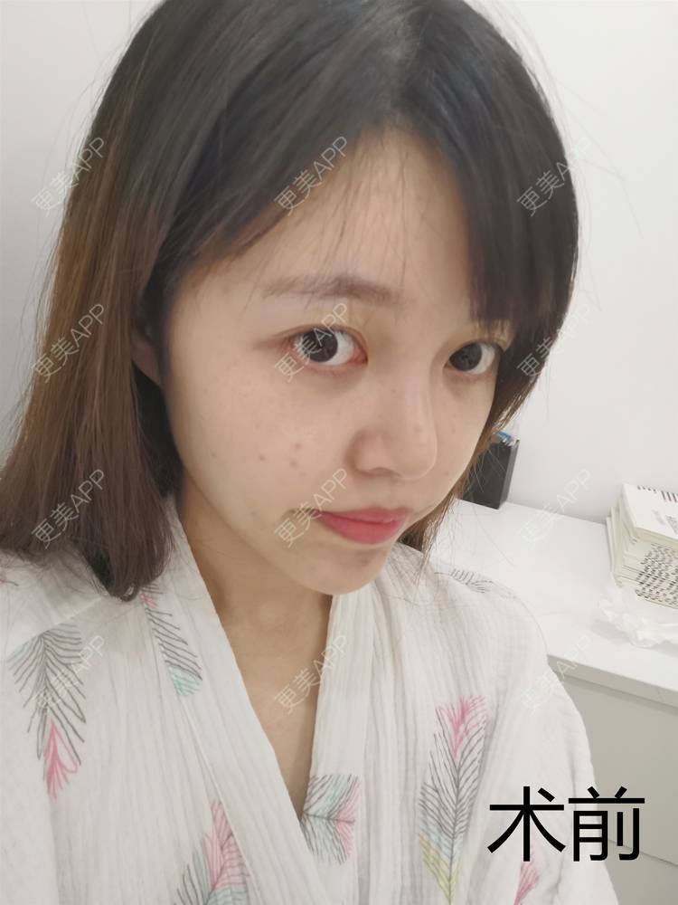 更美 - 一支支支猫的鼻形态修复经验 | 重庆 | 鼻形态修复