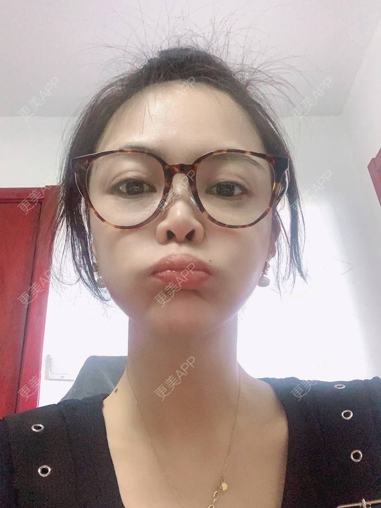 更美 - 更美用户KrKkptdxfh的热玛吉经验 | 热玛吉 | 北京
