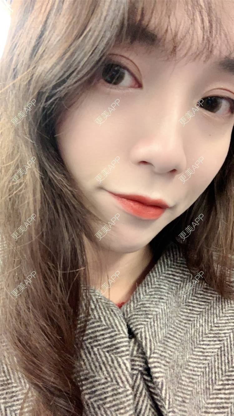 更美 - 更美用户CKvakkeJkI的自体脂肪面部填充经验 | 自体脂肪面部填充 | 郑州