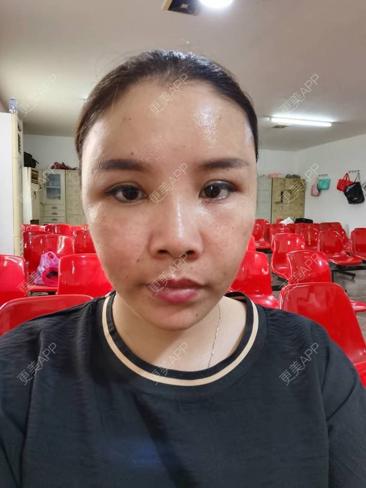 更美 - 更美用户zvR6Y28g4s的自体脂肪全面部填充经验 | 自体脂肪全面部填充 | 自体脂肪面部填充
