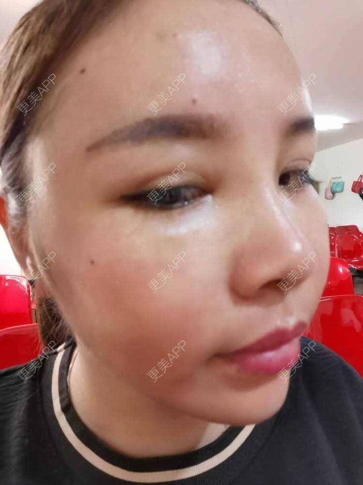 更美 - 更美用户zvR6Y28g4s的自体脂肪全面部填充经验 | 自体脂肪全面部填充 | 自体脂肪面部填充