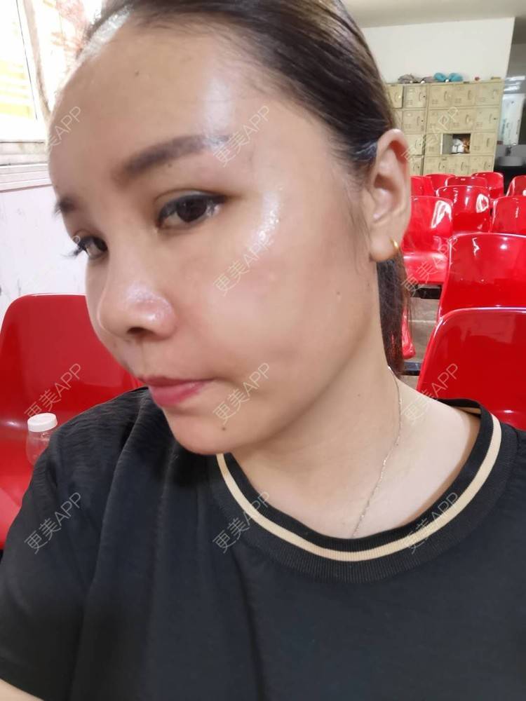 更美 - 更美用户zvR6Y28g4s的自体脂肪全面部填充经验 | 自体脂肪全面部填充 | 自体脂肪面部填充