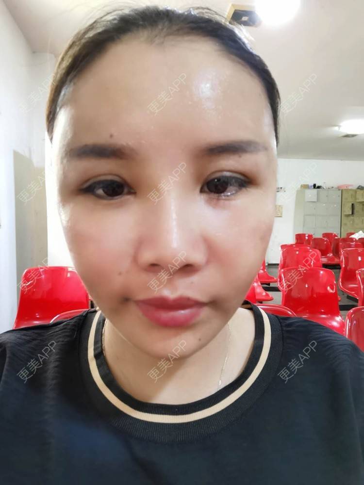更美 - 更美用户zvR6Y28g4s的自体脂肪全面部填充经验 | 自体脂肪全面部填充 | 自体脂肪面部填充