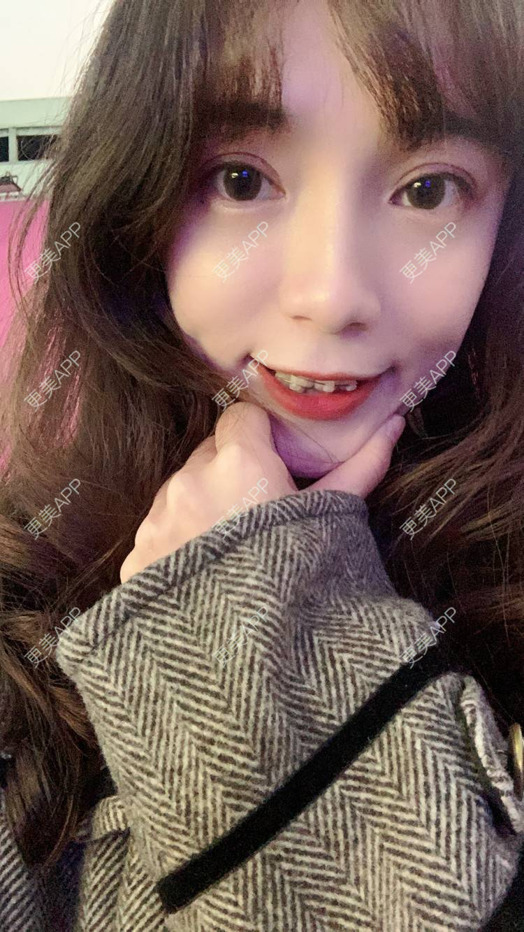 更美 - 更美用户CKvakkeJkI的自体脂肪面部填充经验 | 自体脂肪面部填充 | 郑州