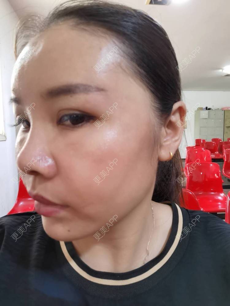 更美 - 更美用户zvR6Y28g4s的自体脂肪全面部填充经验 | 自体脂肪全面部填充 | 自体脂肪面部填充
